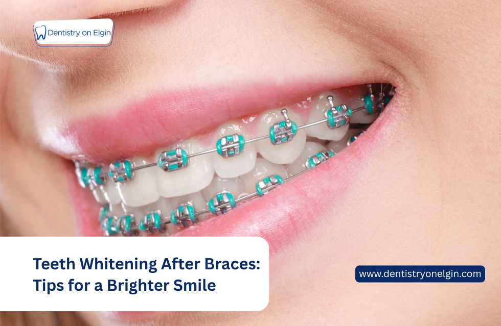 Teeth Whitening After Braces: Tips for a Brighter, Confident Smile